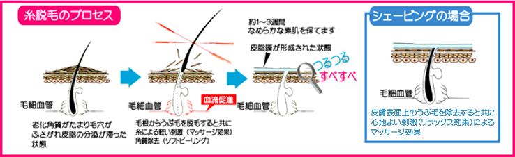 糸脱毛のプロセス